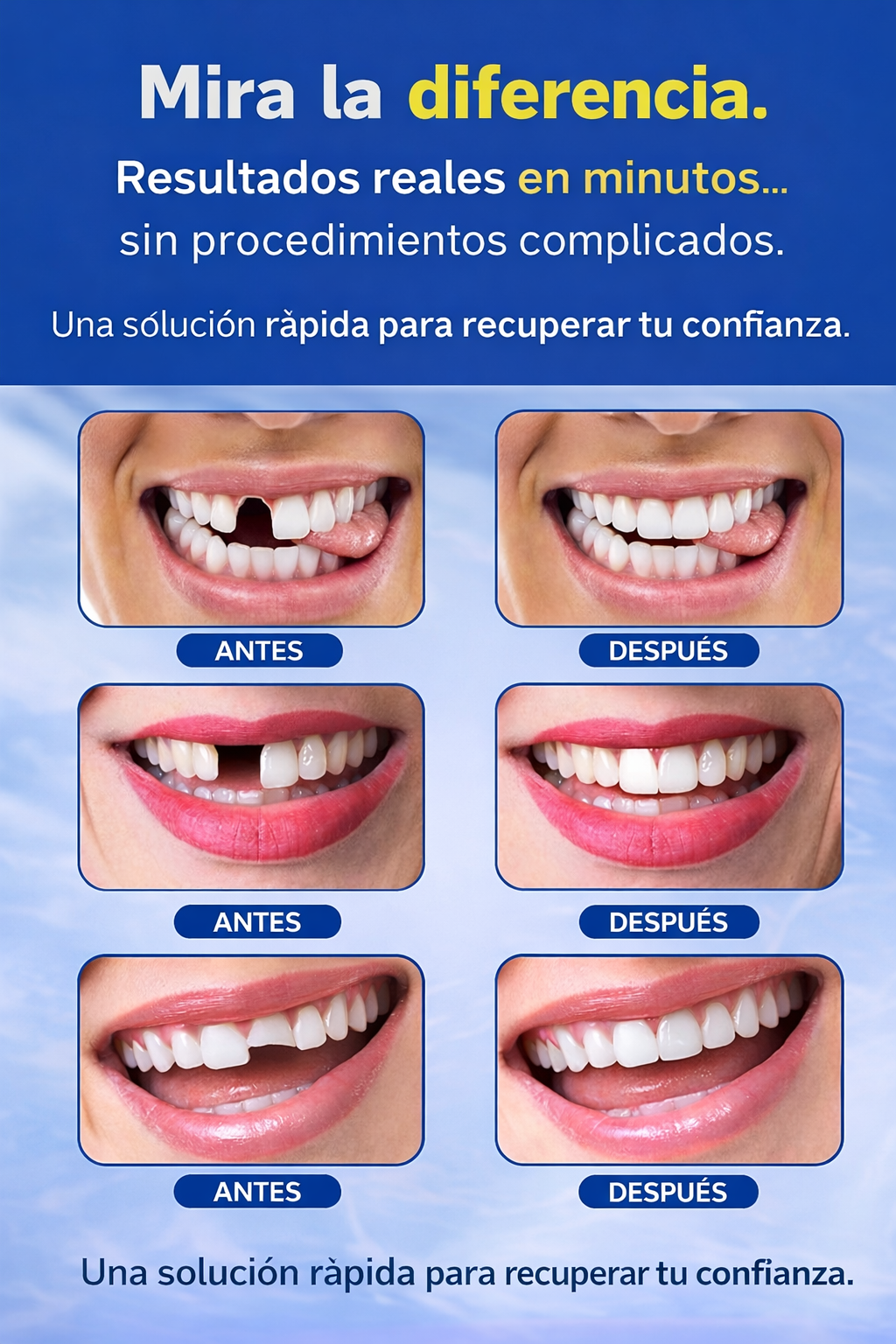 dentix- resina moldeable (hasta 30 dientes)